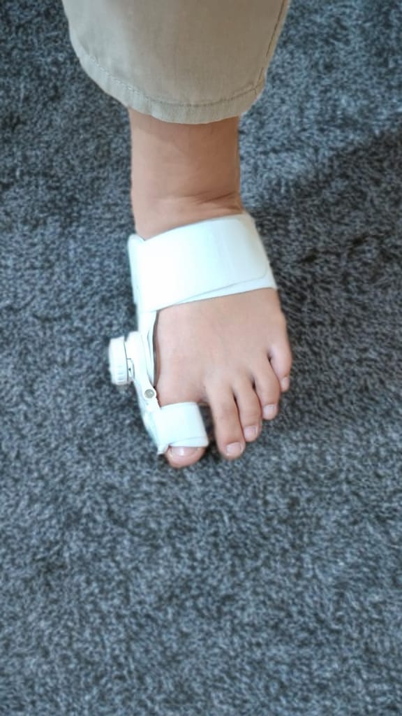Bunion Splint