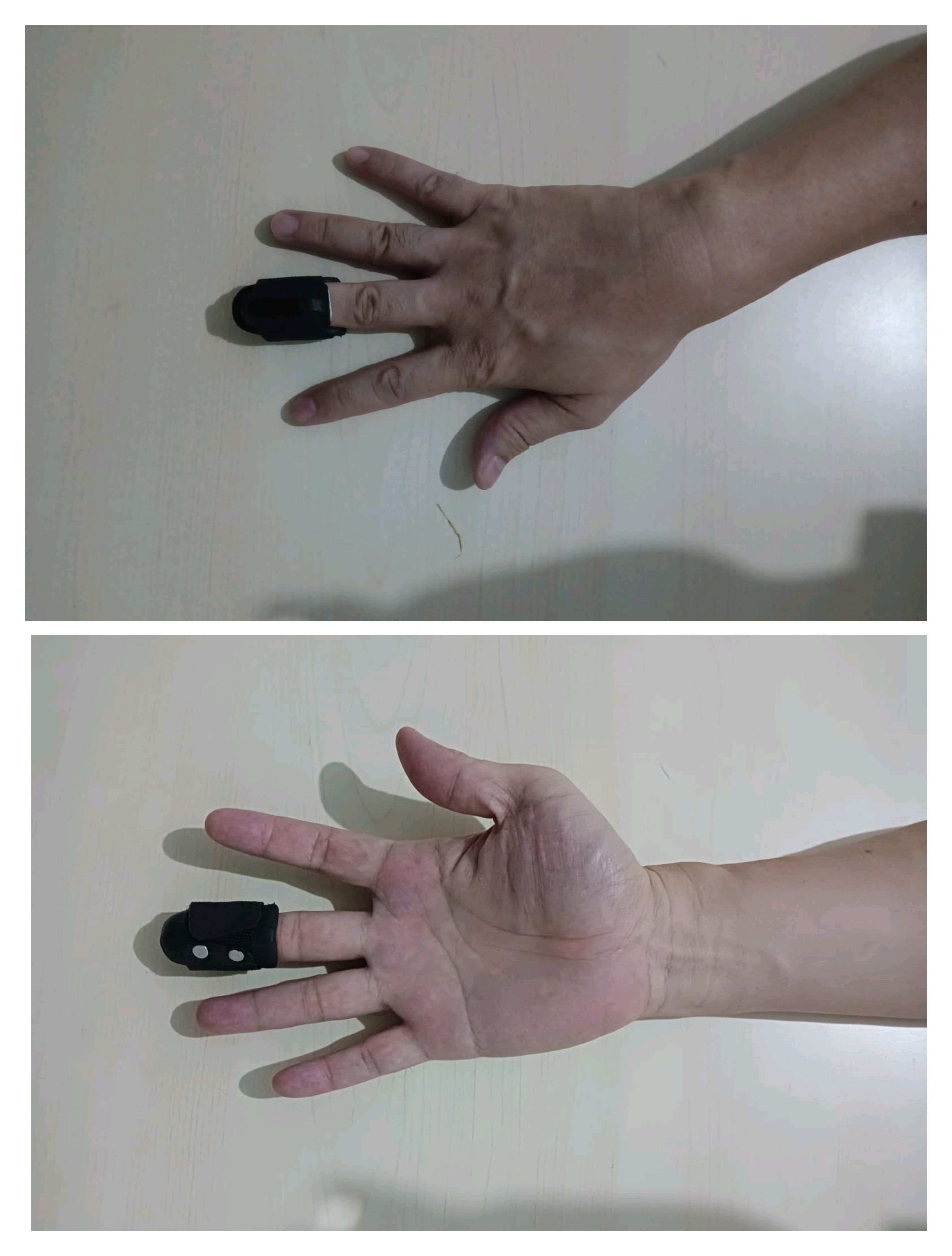 Mallet Finger Splint