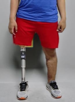 ABOVE KNEE PROSTESIS 1